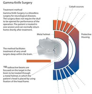 Gamma Knife Surgery Diagram
