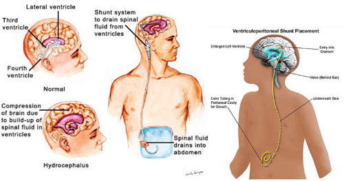 IamA 31 Year Old Female With Hydrocephalus I Have Had 19 BestofAMA