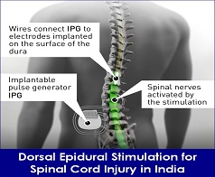 dorsal epidural stimulation treatment india