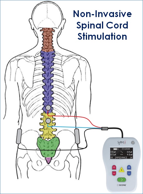 non invasive spinal cord stimulation india