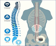 procedure dorsal epidural stimulation treatment india